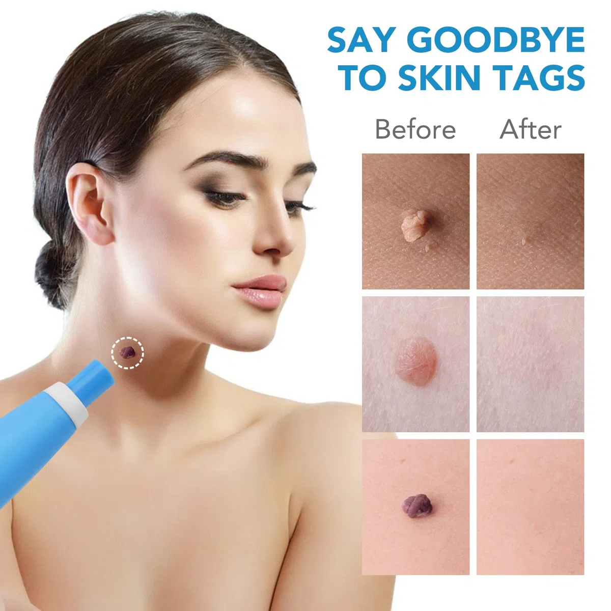 2 IN 1 Skin Tag Removal Kit